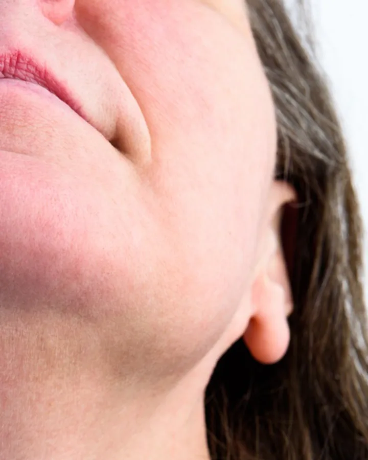 Gesicht & Bart — after OMEGA laser hair removal