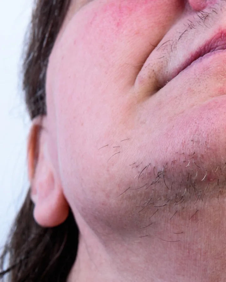 Gesicht & Bart — before treatment
